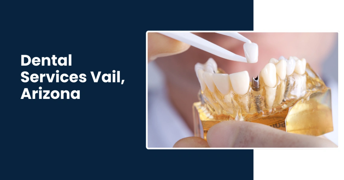 Best Dental Services in Vail, Dental Crowns, Bridges and Implants