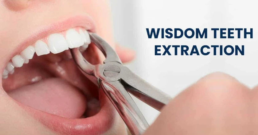 Professional wisdom-tooth-extraction-tucson AZ By Rincon Family Dentistry