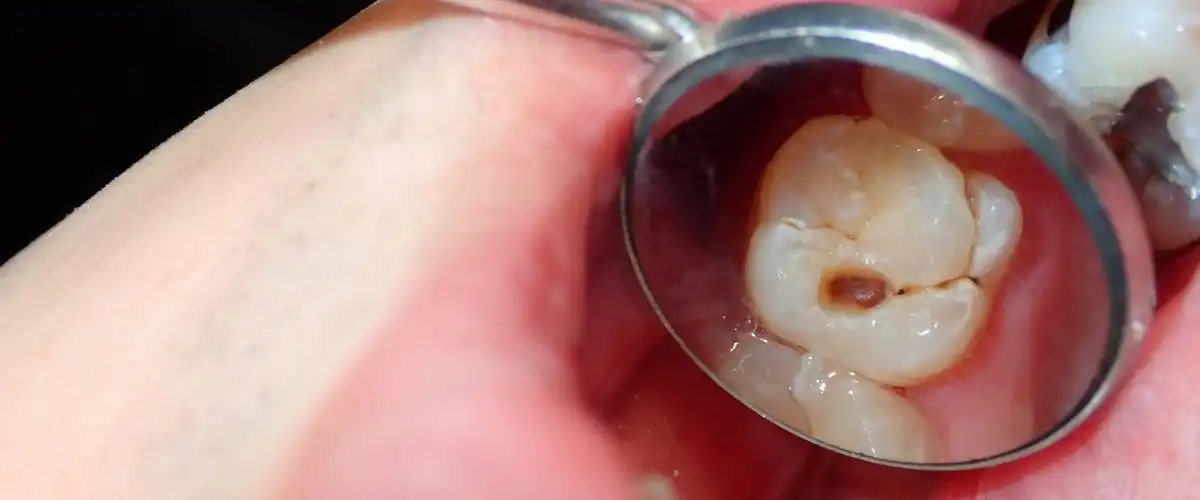 dental cavities
