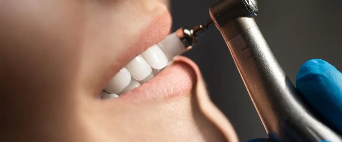 dental cleaning