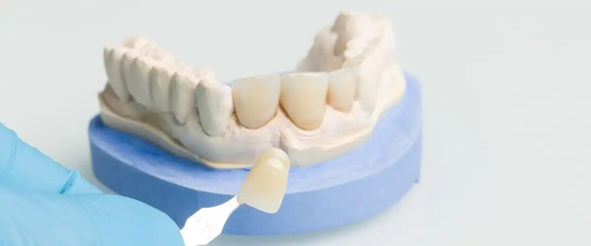 dental crowns