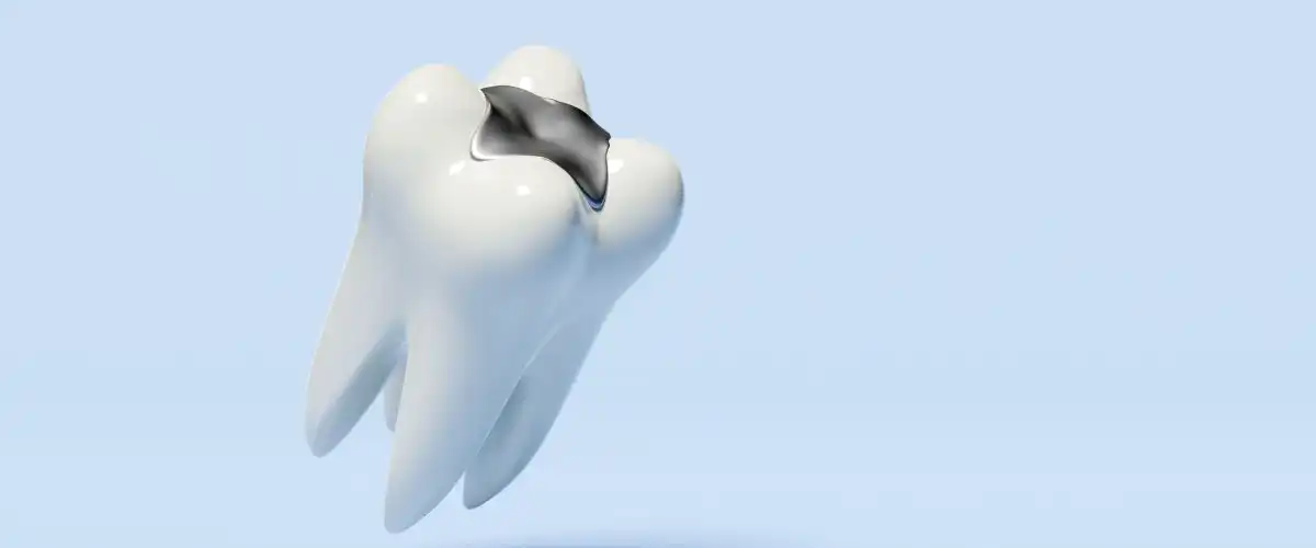 dental fillings