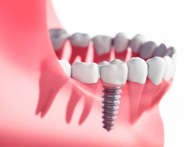 dental implants restoration in tucson az (2)