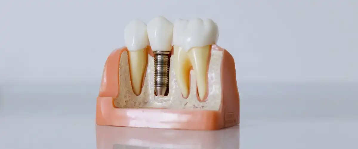 dental implants