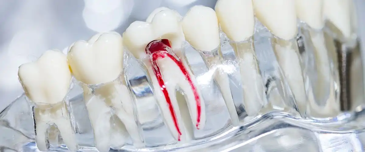root canal