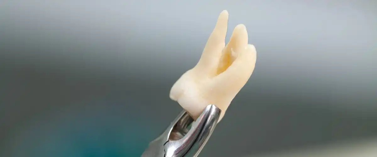 wisdom teeth extraction