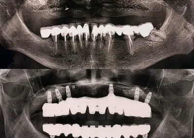 3D imaging for bone graft placement in jaw-Rincon Family Dentistry