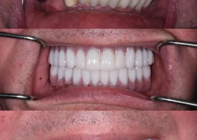 Artificial bone graft treatment at Rincon Family Dentistry in Tucson- before & after