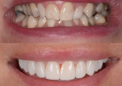 Before & after results of braces for teeth straightening-Rincon Family dentistryin Tucson