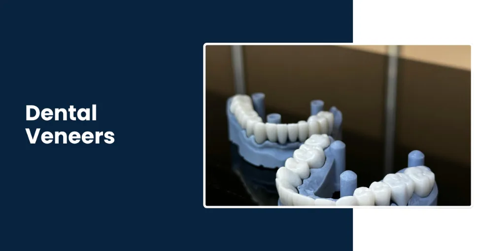 Best Dental Veneers in Tucson, AZ - by Rincon Family Dentistry Best Dental Veneers in Tucson, AZ - by Rincon Family Dentistry