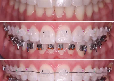 Braces application on a patients teeth before & after - by Rincon Family Dentistry Orthodontist