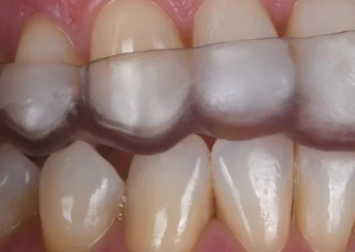 Bruxism mouth guard application in Tucson - before & after