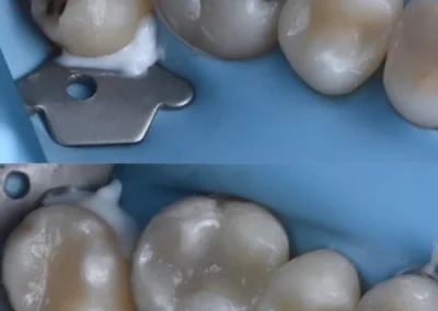 Ceramic teethinlays treatment-before & after