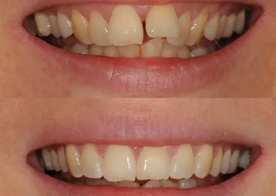 Clear Aligners for teeth straightening-Before and after