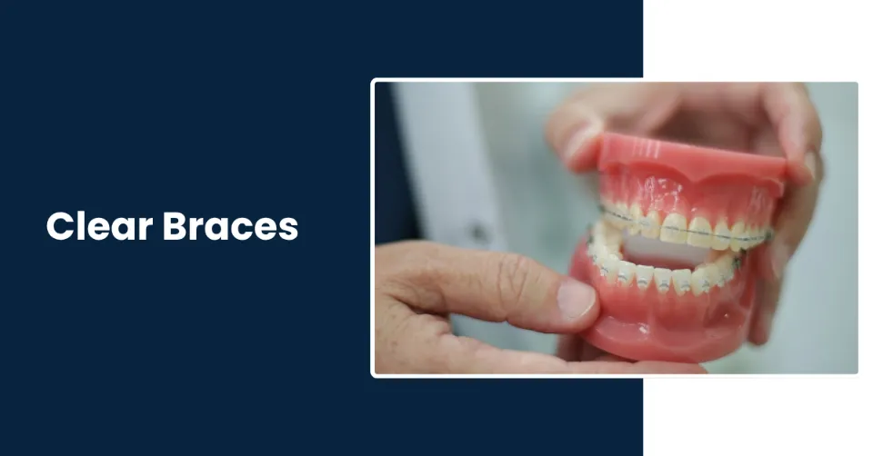 Clear Braces Treatment in Tucson AZ by Rincon Family Dentistry Specialist Clear Braces Treatment in Tucson AZ by Rincon Family Dentistry Specialist