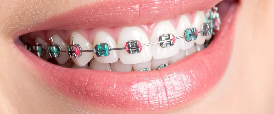 Clear braces