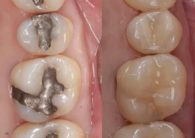 Composite Inlays and onlays application-before and after