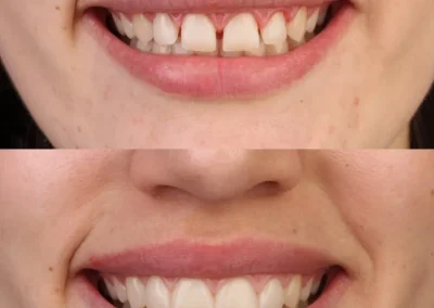 Composite Veneers for front teeth -before & after