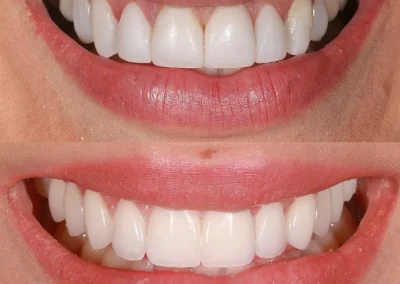 Cosmetic dental treatment for smile makeover at Rincon Family Dentistry in Tucson - Before & after