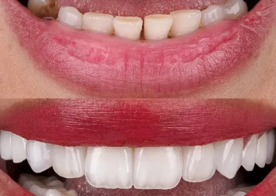 Cosmetic dental veneers for gaps - before & after