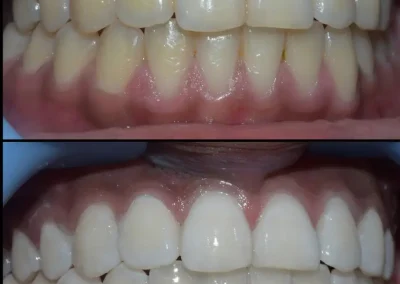 Deep teeth cleaning in Our Tucson dental office- before & after