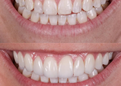 Dental Flouride Coating Treatment - Before and After