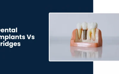 Dental Implants Vs Bridges: Which is the best to choose?