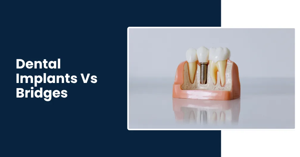 Dental Implants vs Dental Bridges_ Pros & Cons, Key Difference and Which is Best