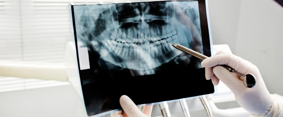 Dental X-rays and Digital Imaging