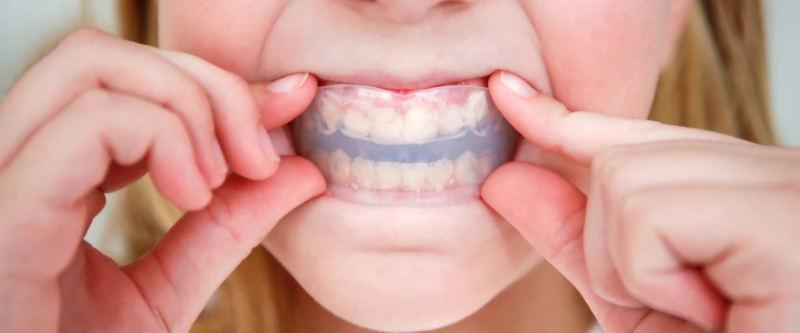 Dental mouth guard