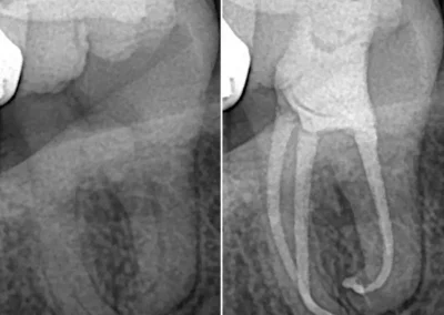 Dental radiograph for infected teeth at Rincon Family Dentistry