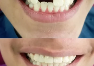 Dental sealent application for tooth loss recovery at Rincon Family Dentistry - before & after