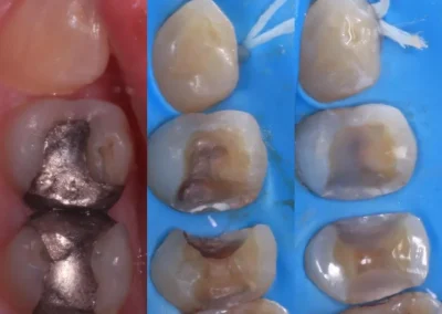 Dentin sealing
