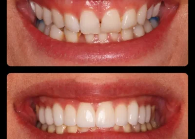 Full mouth composite bonding for cracked tooth