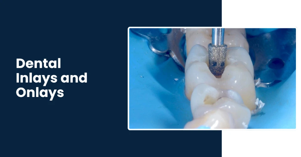 High quality dental inlays and onlays in Tucson AZ - Rincon Family Dentistry High quality dental inlays and onlays in Tucson AZ - Rincon Family Dentistry