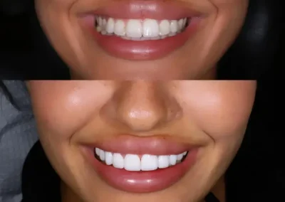 High quality porcelain veneers application - before & after