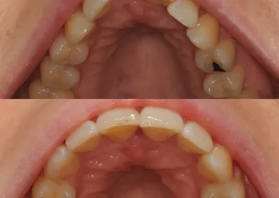 Invisalign Clear Aligners - Before & After