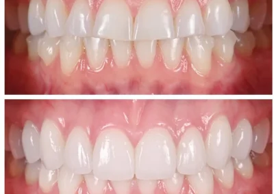 Night Guard for occlusal treatment - before & after