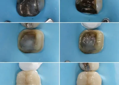 Occlusal teeth restoration with dental sealent application - before & after