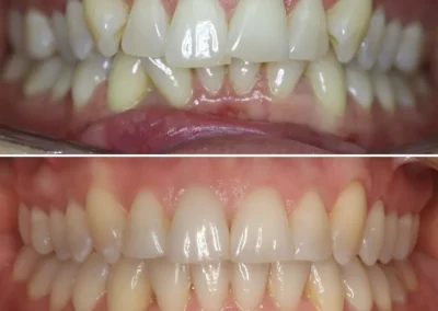 Orthodontic Clear Aligners for Teeth Straigtening-Before & After