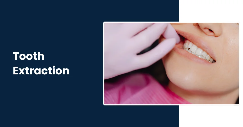 Painless teeth extraction & treatment services in Tucson - Rincon Family Dentistry Painless teeth extraction & treatment services in Tucson - Rincon Family Dentistry