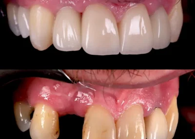 Periodontal bone grafting for mouth by Rincons Family Dentistry Specialist in Tucson- before & after