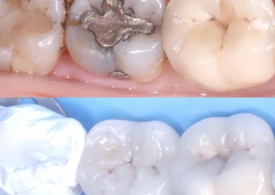 Porcelain inlays and onlays service-before & after