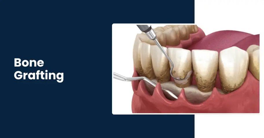 Professional Dental Bone Grafting Treatment in Tucson AZ-Rincon Family Dentistry Professional Dental Bone Grafting Treatment in Tucson AZ-Rincon Family Dentistry