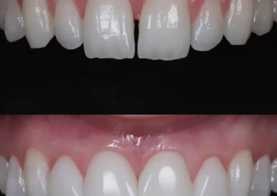 Removable lumineers - before & after