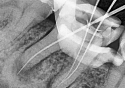 Root canal treatment with CBCT dental X-ray at Rincon Family Dentistry in Tucson