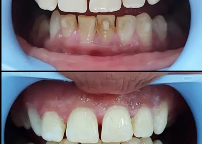 Scaling and root planning-before & after