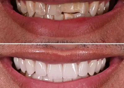 Smile makeover with veneer and bridge at Rincon Family Dentistry in Tucson - beofre & after