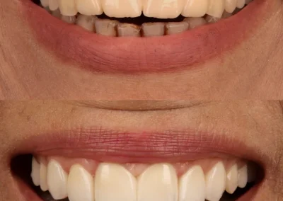 Smile restoration with dental bonding and cementing - before & after