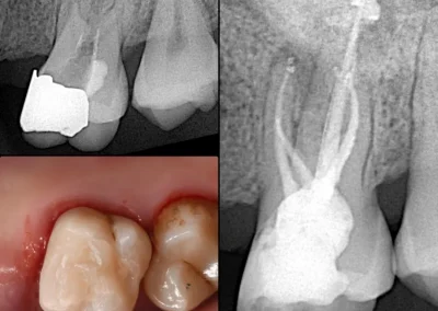 Teeth X-ray for impacted teeth - Rincon Family Dentistry Tucson